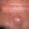 Sebaceous Cyst On Forehead