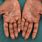 Severe Eczema On Hands