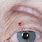 Skin Cancer On Upper Eyelid