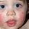 Skin Rash On Toddler