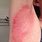 Skin Rash Under Armpit