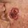 Squamous Cell Carcinoma Skin Cancer