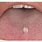 Squamous Papilloma On Tongue