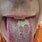 Syphilis Sores On Tongue