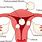 Types of Fibroids