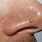 Wart On Side of Nose