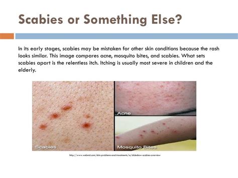 Best Way To Treat Scabies Natural Treatments For Scabies