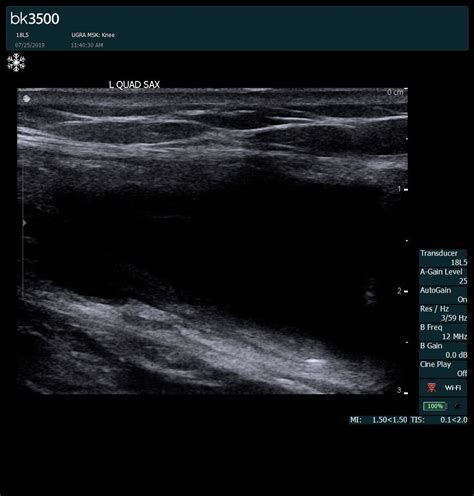 Case Study: Ultrasonography as an Effective Imaging Mode for Hip Labral Detachment - NYDNRehab.com