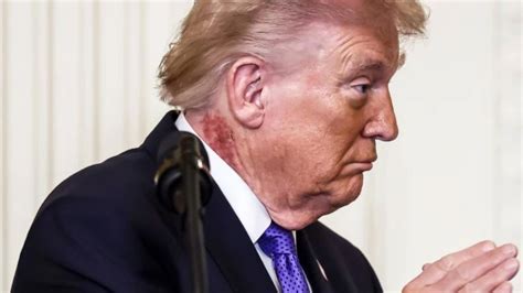 What is chronic venous insufficiency? Donald Trump's diagnosis and 'swollen ankles' explained