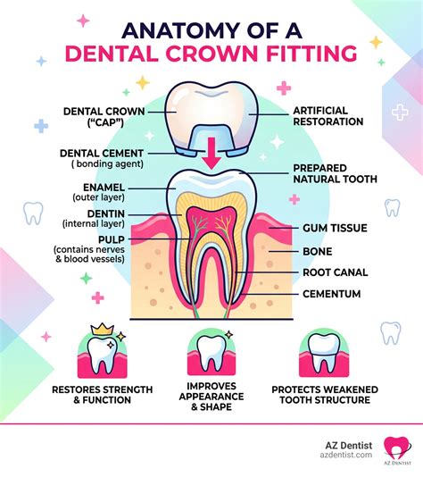 What Are Dental Crowns: Top 5 Ultimate Guide