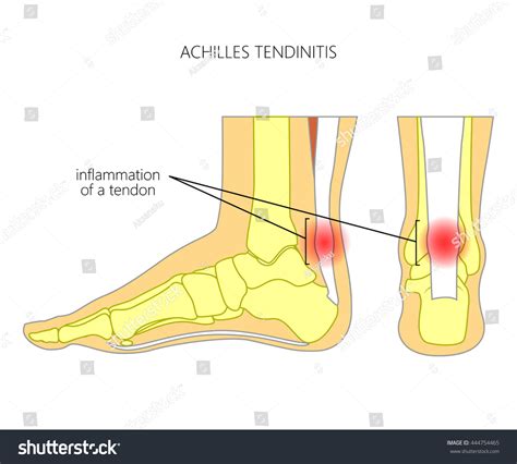 6,5 тысячи рез. по запросу «Tendinitis sprain tear» — стоковая векторная графика | Shutterstock