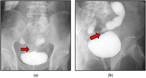 Urothelial Bladder Carcinoma Incidentally Coexisting with an Ileovesical Fistula Caused by ...