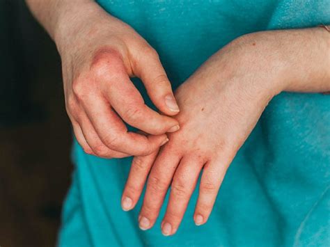 Types of Eczema: Symptoms, Causes, and Pictures