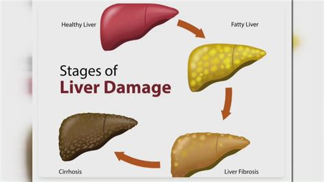 Hormone therapy prescriptions skyrocket amid estrogen patch shortage | wwltv.com