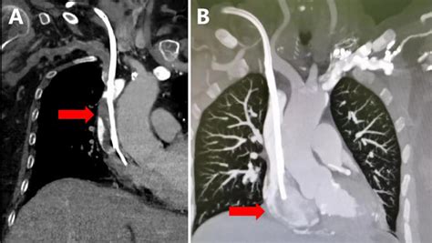 Catheter replacement combined with antiplatelet therapy in hemodialysis ...