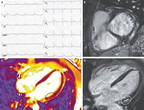 Myocarditis | New England Journal of Medicine