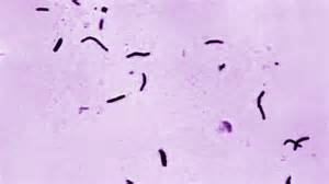 Tuberculosis outbreak hits Newfoundland and Labrador