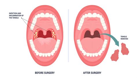 Tonsil Stones vs Strep: Is There A Difference? - Face Surgery