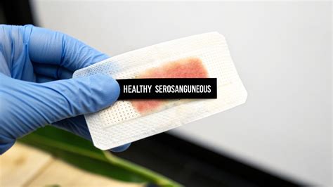 What Are the Different Types of Wound Drainage Telling You?