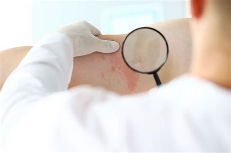 Sexually Transmitted Ringworm Hits Minnesota in ’Largest Known Outbreak’