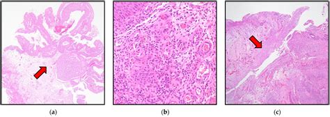 Urothelial Bladder Carcinoma Incidentally Coexisting with an Ileovesical Fistula Caused by ...