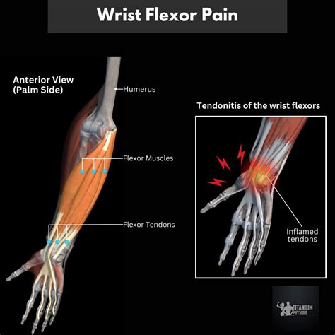 Forearm and Wrist Tendonitis | Root Causes & Relief Exercise