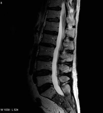 Prostate cancer | Radiology Reference Article | Radiopaedia.org
