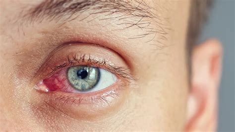 What Is Opti-Lift IPL?