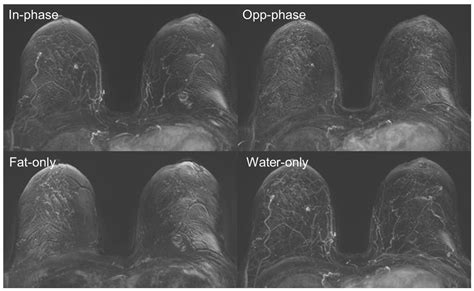 Evaluation of Individual T1w-DIXON Contrasts for Subtraction Generation in Dynamic Contrast ...