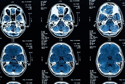 Image result for Add Brain Scan