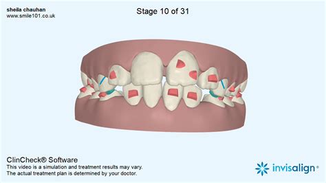 Image result for Invisalign ClinCheck