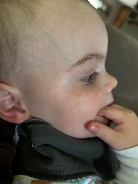 Freckles vs Petechiae | BabyCenter