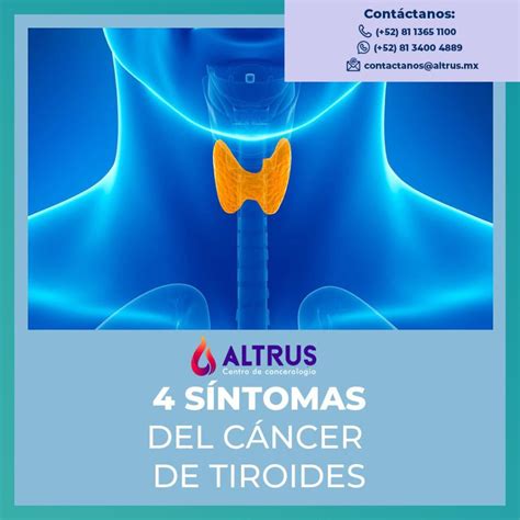 Cáncer de tiroides - ALTRUS cancerología