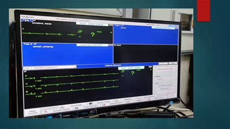 Image result for Telemetry Monitoring Basics