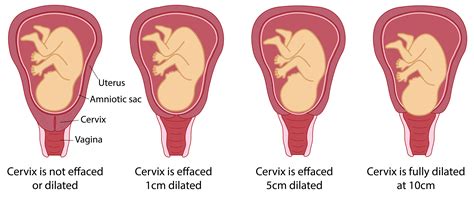 Stages Of Labor Cervical Dilation: The Stages Of Labor In Pictures