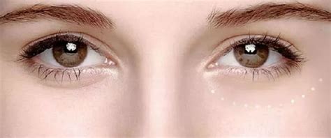 眼睛过敏导致眼周起皱纹怎样消除？还可以恢复吗？ - 知乎