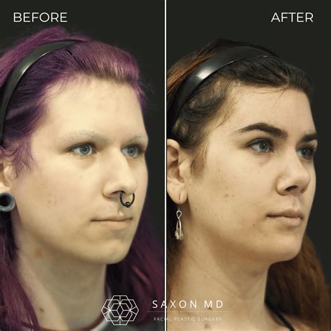 Facial Feminization Surgery Before And After Photos | FFS Austin & Dallas, TX