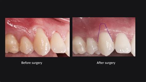 A Solution to Gum Recession - Perio & Implant Dental Referral Centre