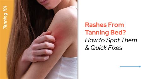 How To Treat Sunburn From Tanning Bed at Monte Rodriquez blog