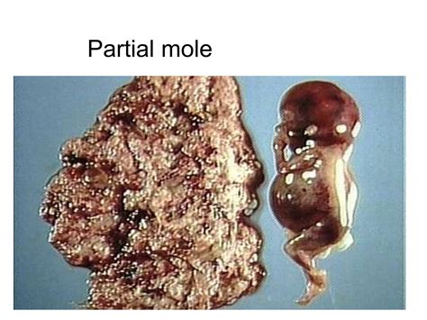 Partial Molar Pregnancy