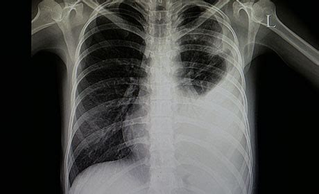 No Benefit Found in Using Broad-Spectrum Antibiotics as Initial ...