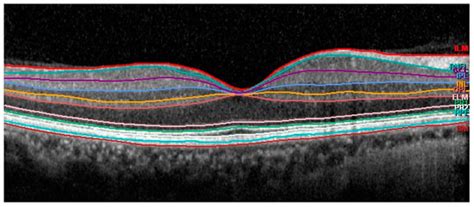 Glaucomatous Maculopathy: Thickness Differences on Inner and Outer ...