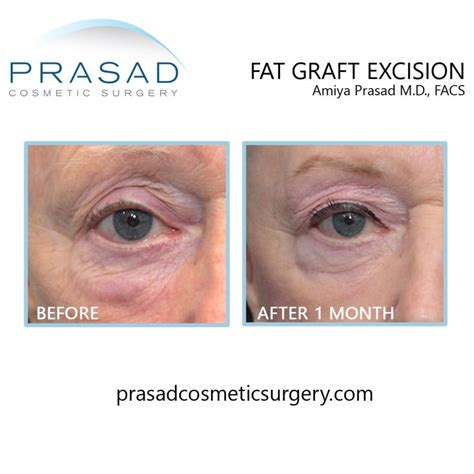 Under Eye Fat Transfer