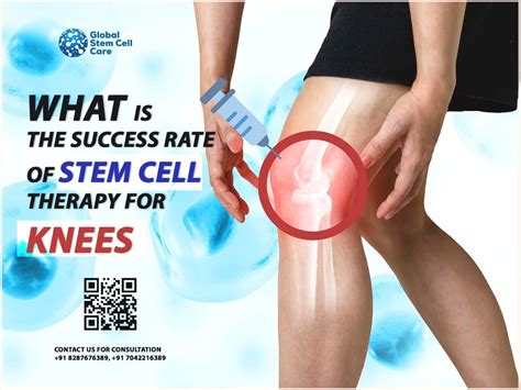 What Is the Success Rate of Stem Cell Therapy for Knees