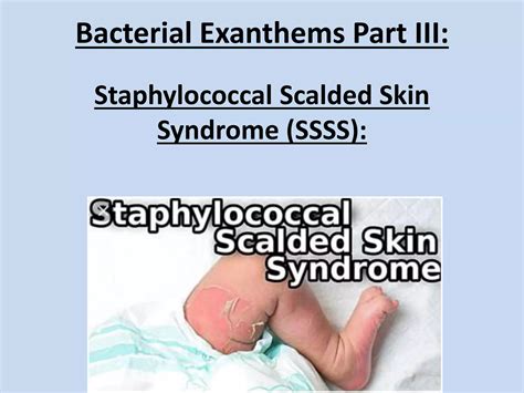 Staphylococcal Scalded Skin Syndrome Made Very Easy | PPTX