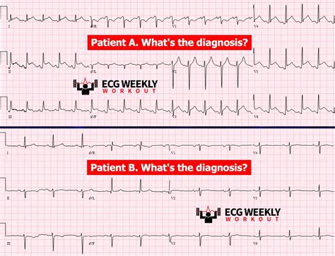 STAT ECG Diagnoses: are ECG abnormalities necessary for the diagnosis ...