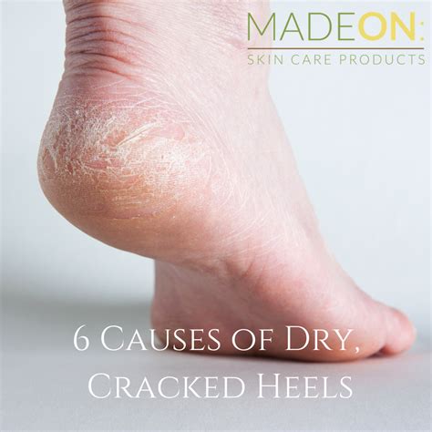 How to heal deep, cracked heels – MadeOn Skin Care