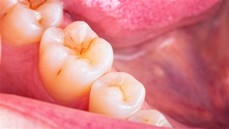 How Long Can a Cavity Go Untreated? | True Dental