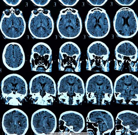 脑部检查核磁共振和CT哪个好？