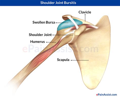 Shoulder Joint Bursitis|Causes|Symptoms|Treatment-Conservative, PT, Surgery
